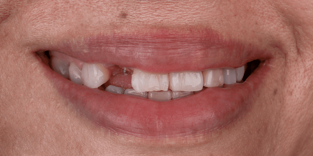 Before Implante dental de zirconio en zona estética