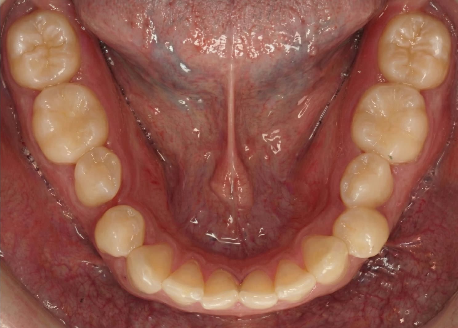 Before Invisalign, 6 meses