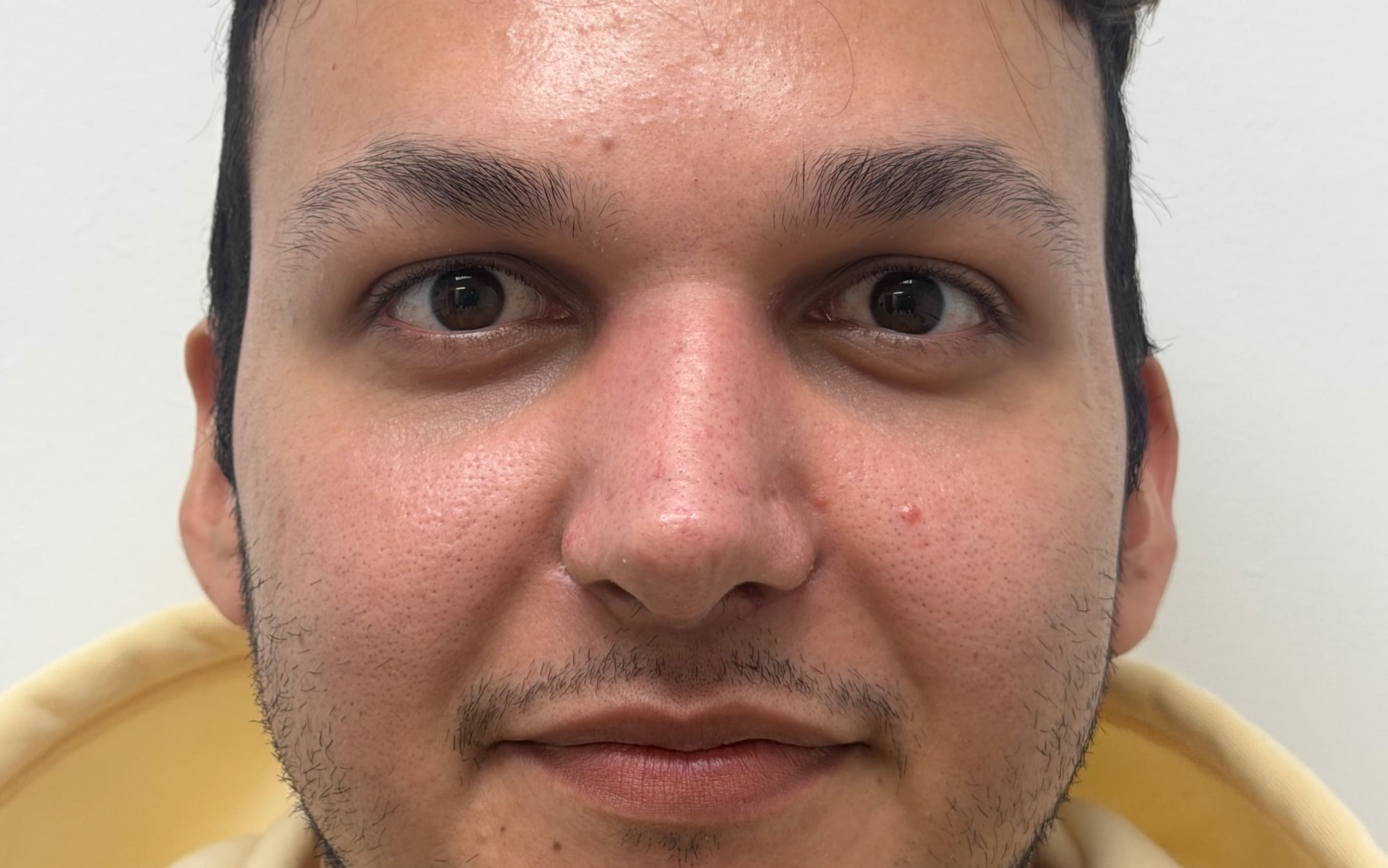 After Male rhinoplasty
