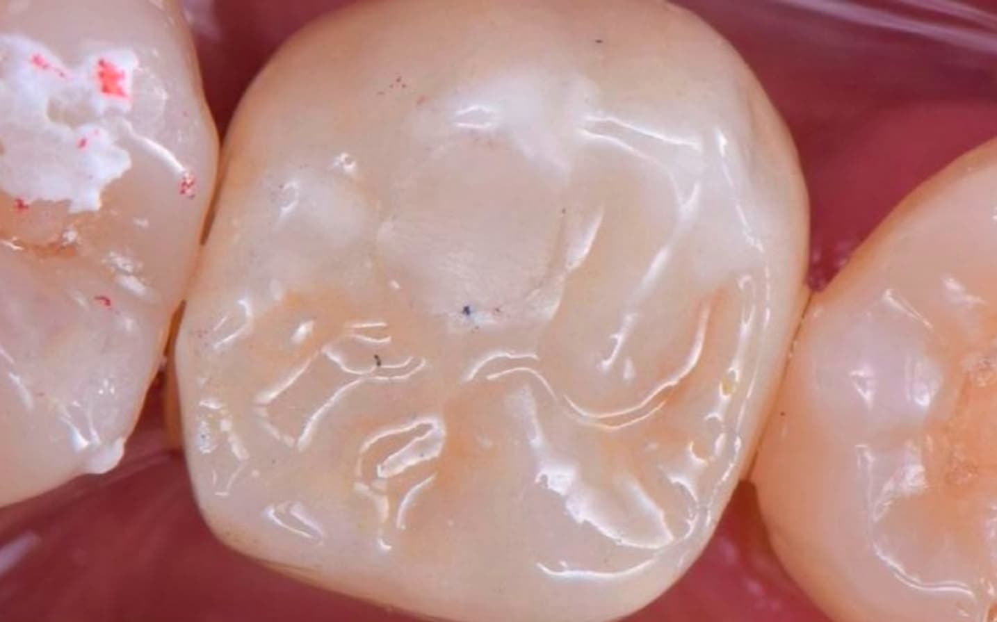 After Dental Implant and Zirconia Crown on Implant