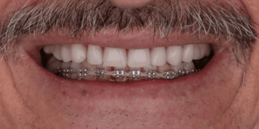 After Prótesis híbrida superior