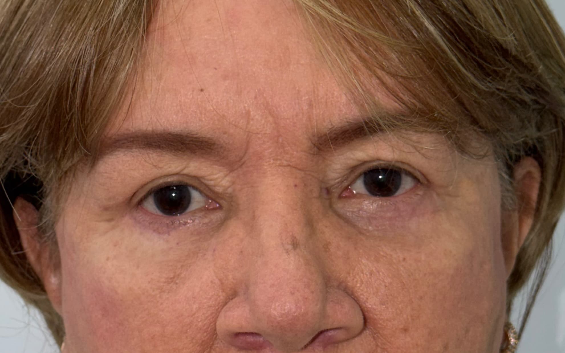 After Blepharoplasty