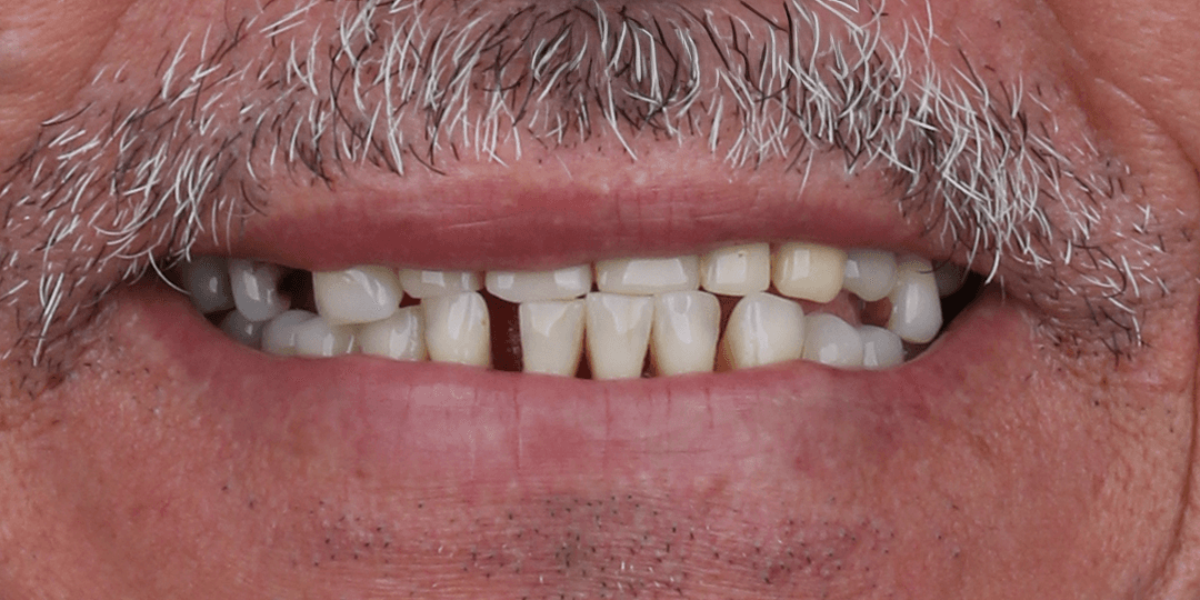 Before Prótesis híbrida superior