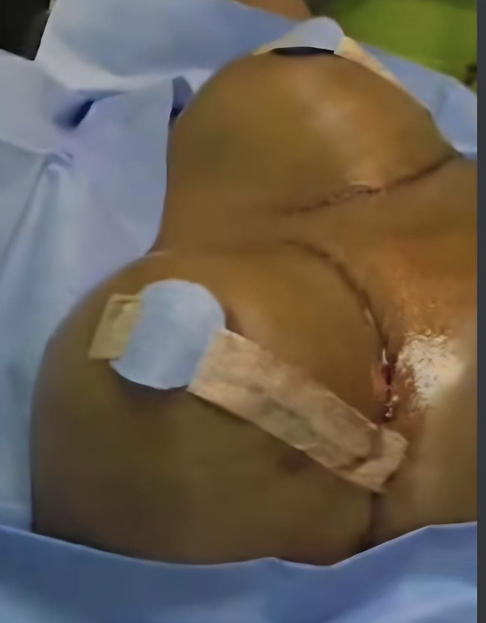 After Reducción de senos sin implantes