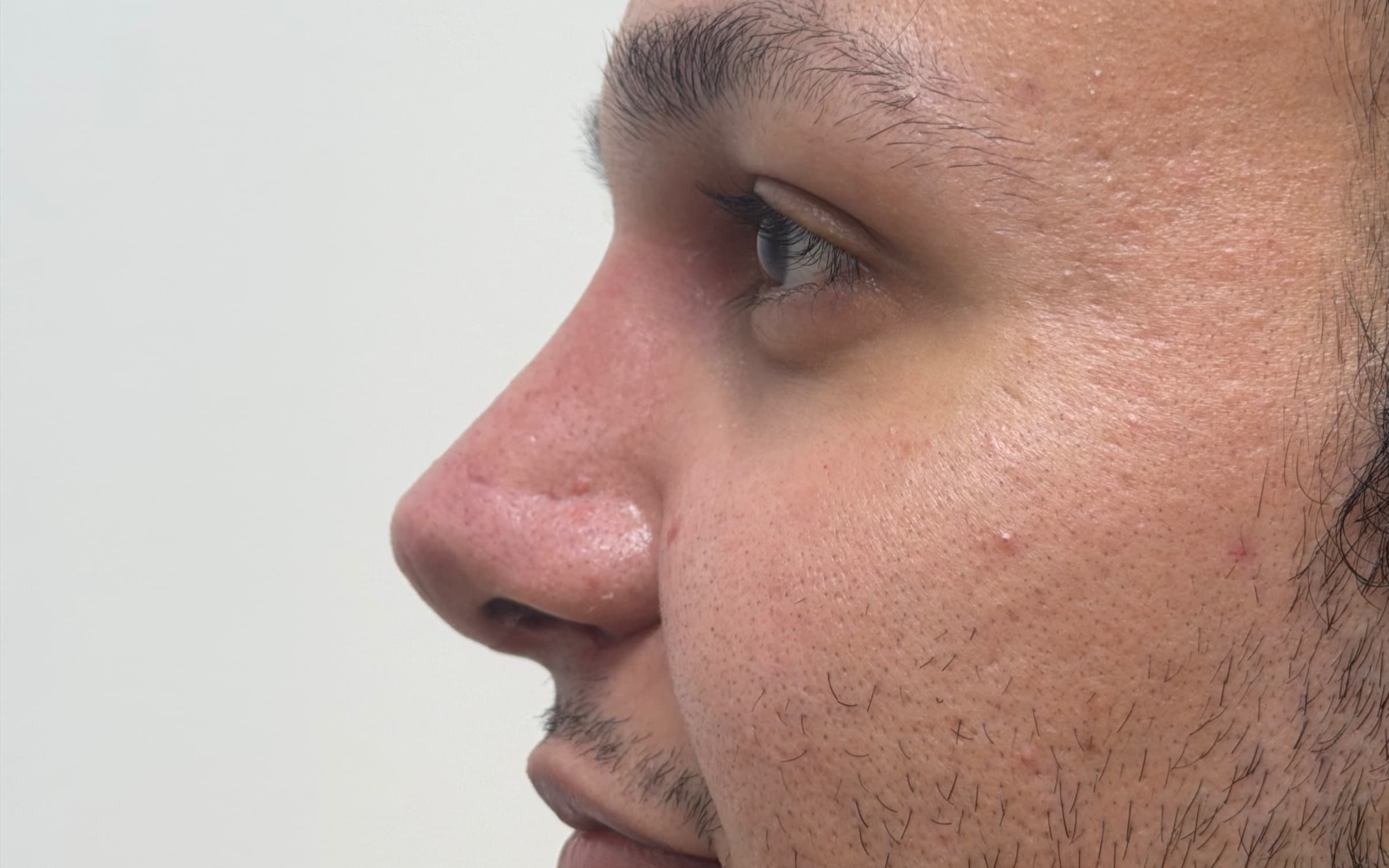 After Male rhinoplasty