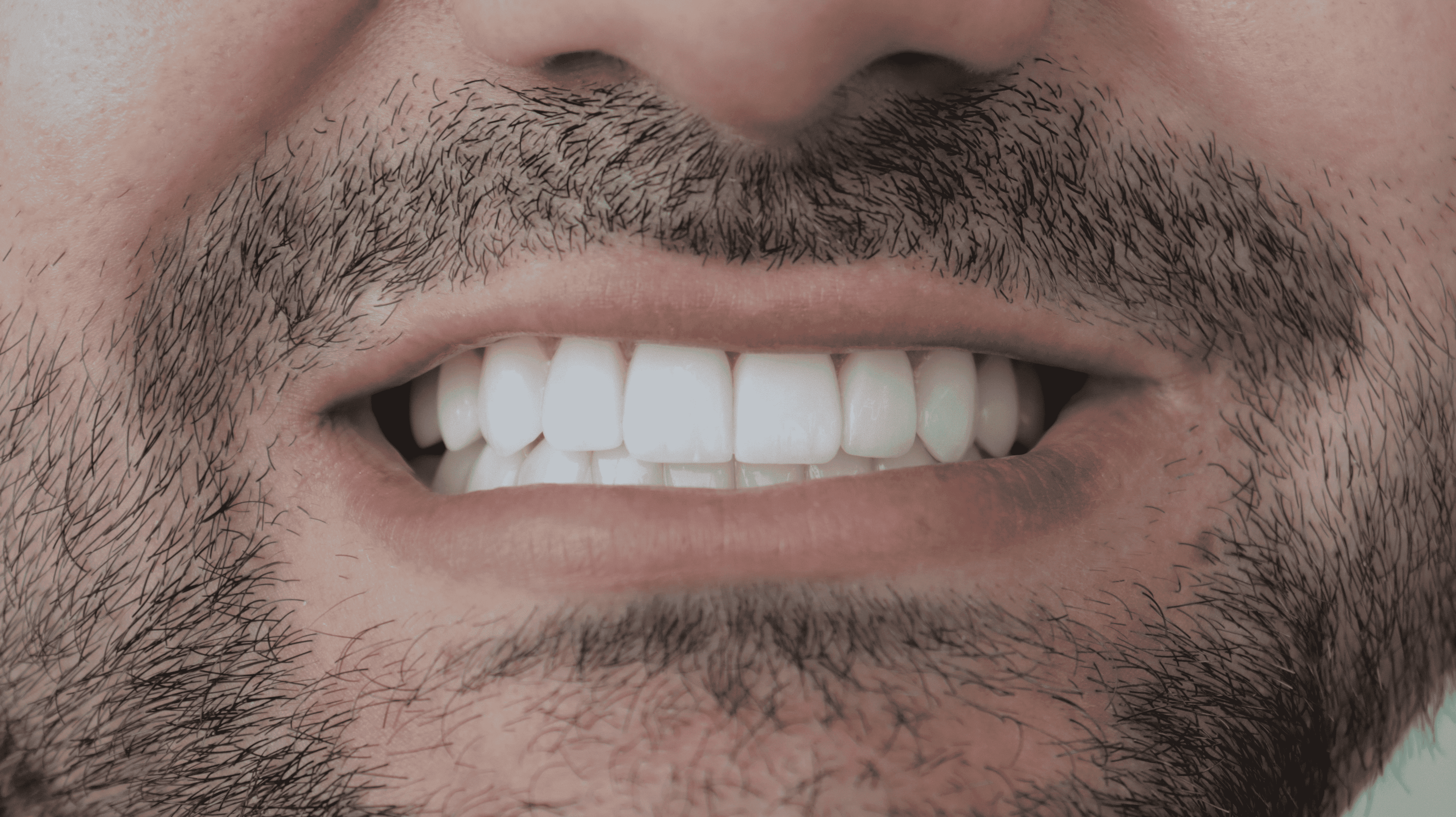 After Lentes cerámicos naturales