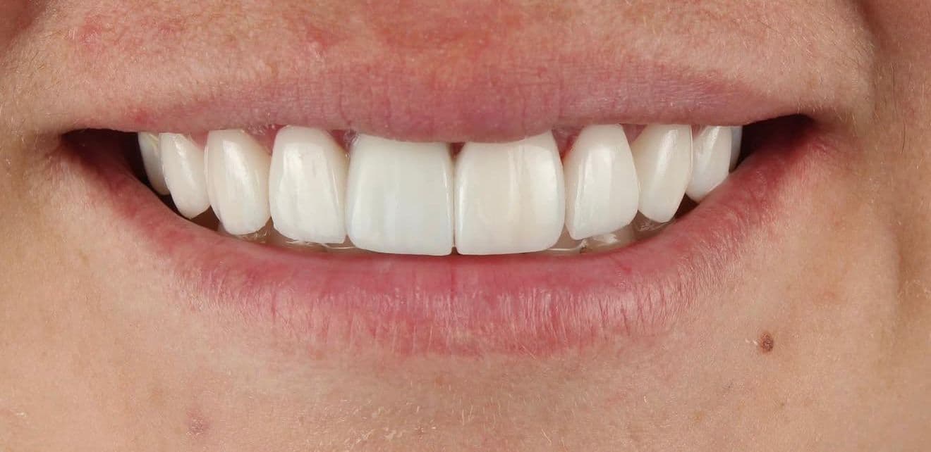 After carillas dentales en cerámica