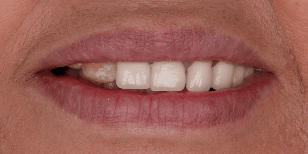 Before Prótesis híbrida superior