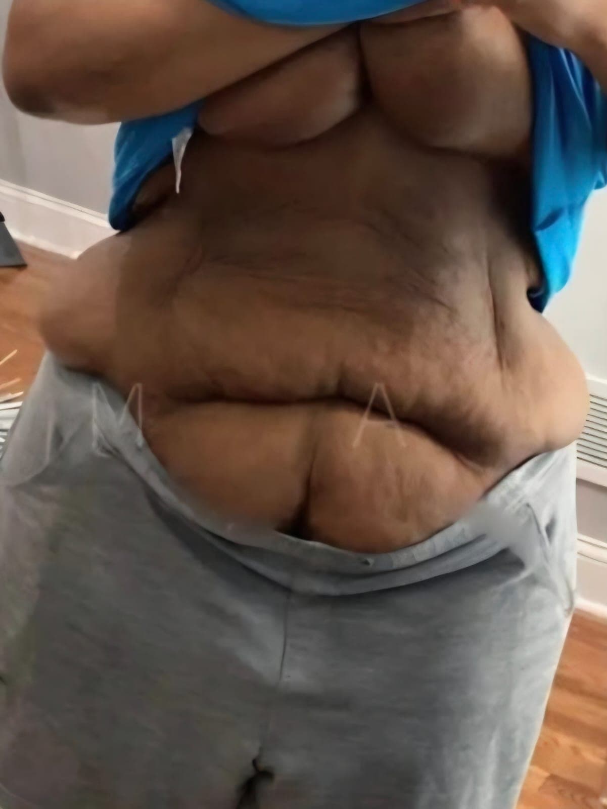 Before Abdominoplastia