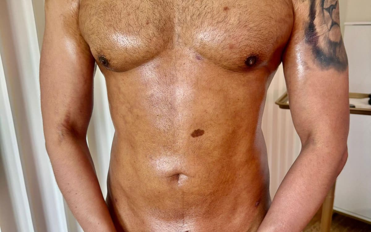 After Male liposuction