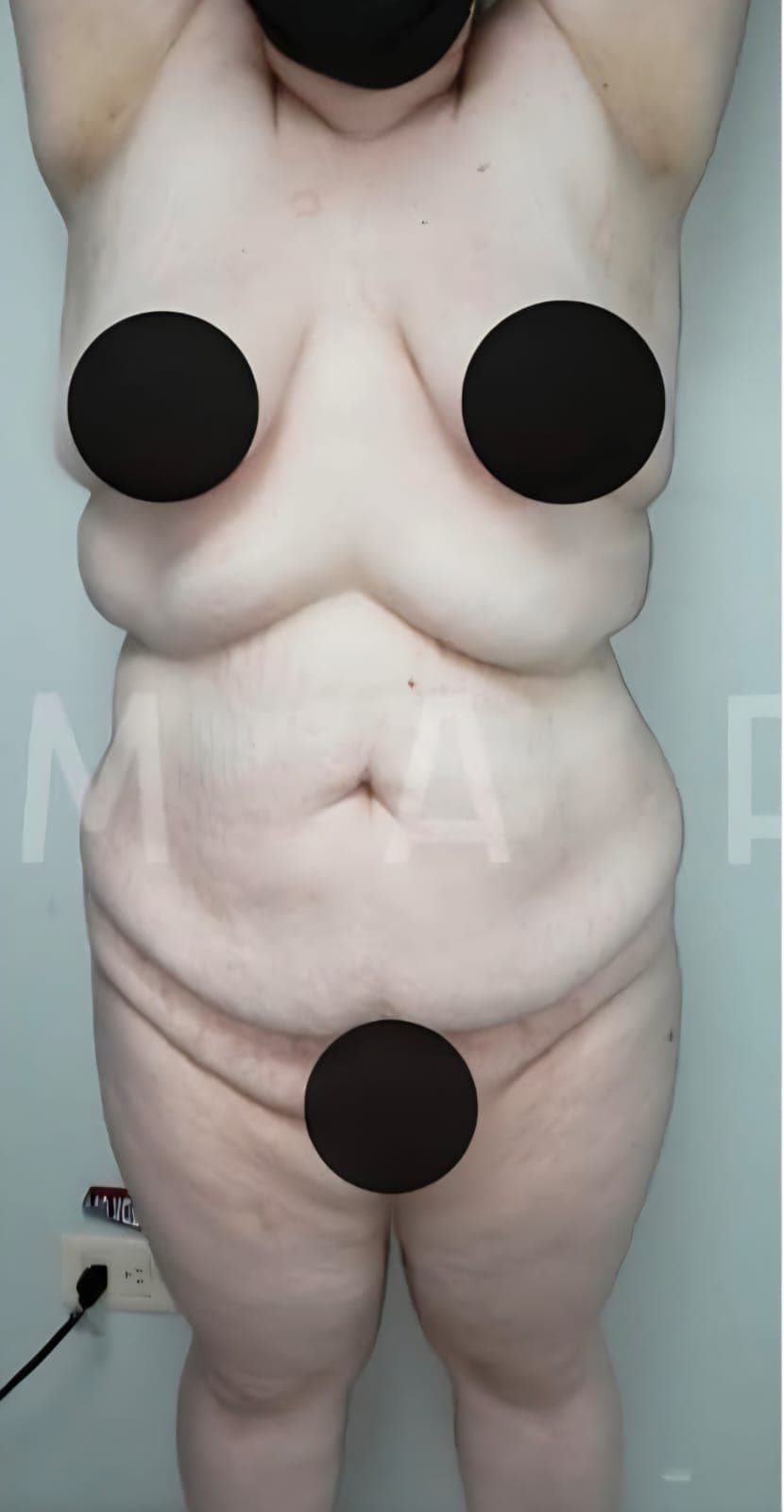 Before Abdominoplastia (tummy tuck)