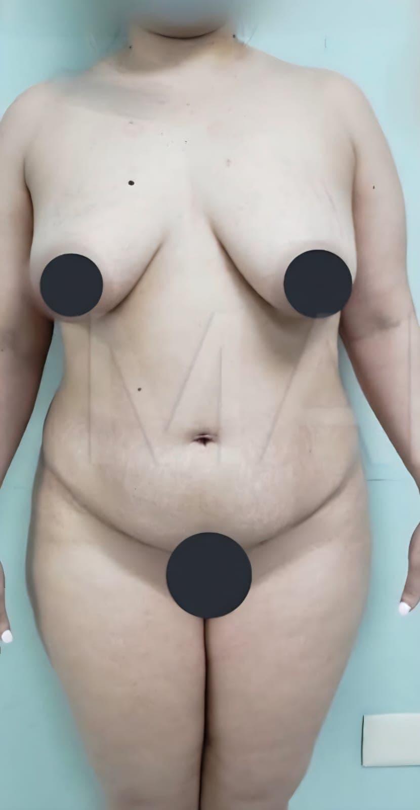 Before Abdominoplastia, liposucción y senos