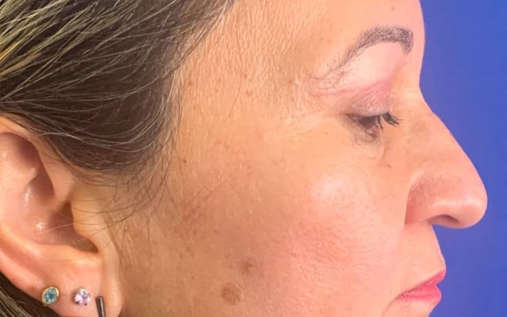 After Blepharoplasty
