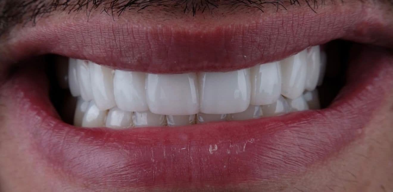 After carillas dentales en cerámica