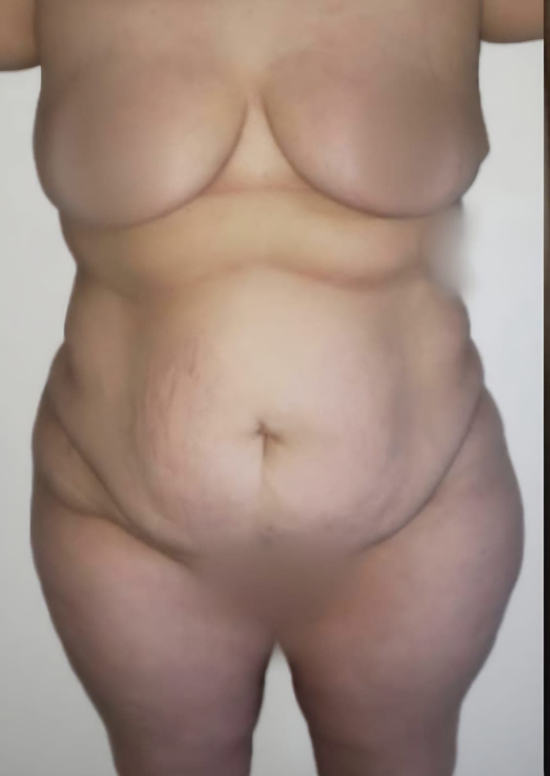 Before Abdominoplastia