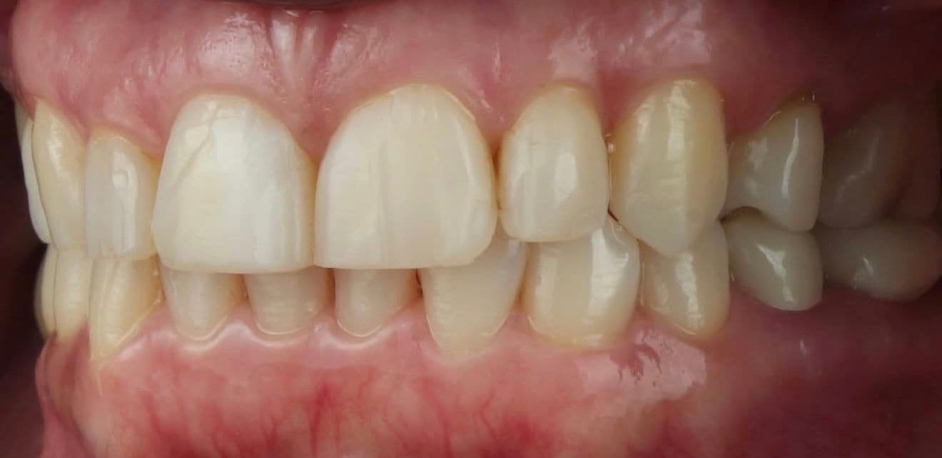 Before carillas dentales en cerámica