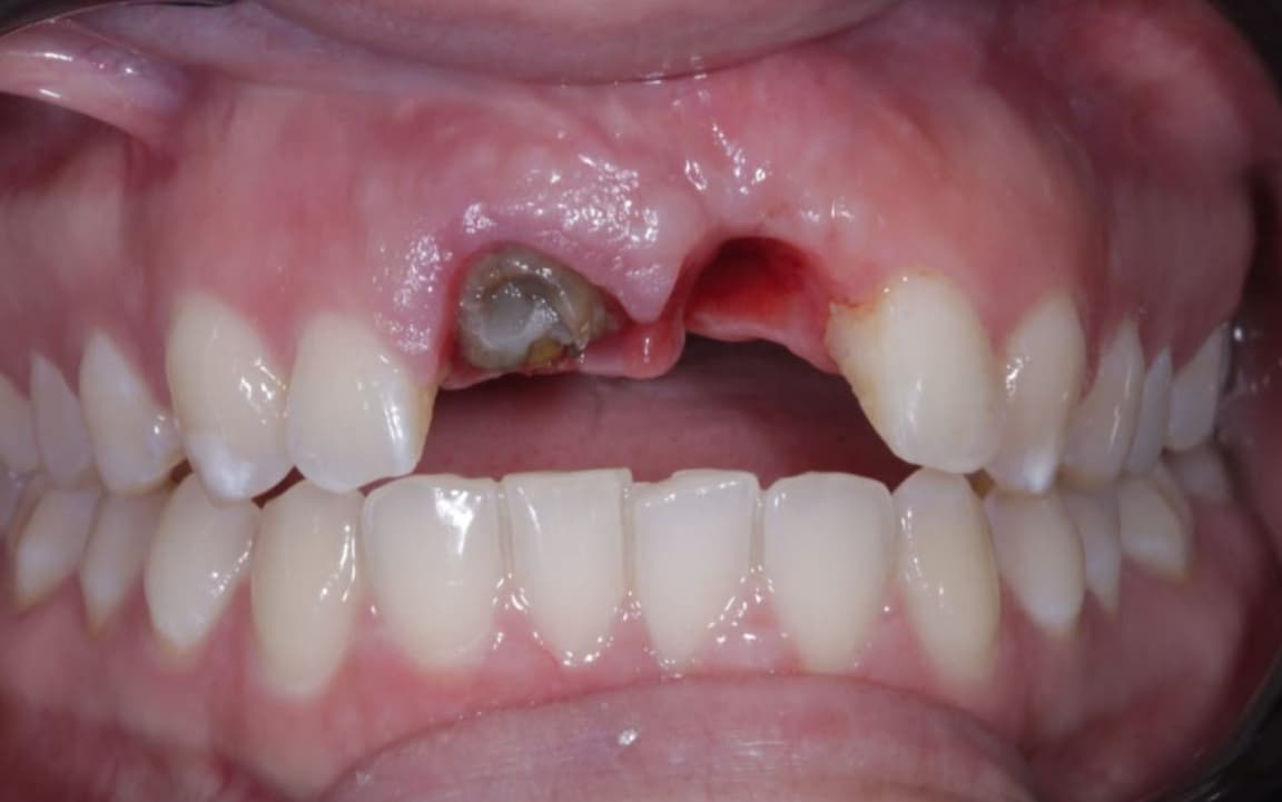 Before Dental Implant and Zirconia Crown on Implant