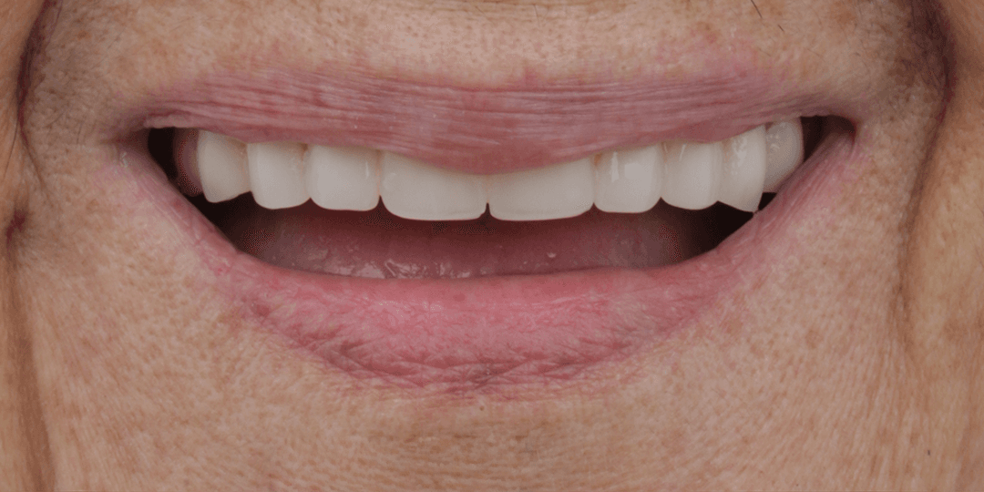 After Prótesis híbrida Superior