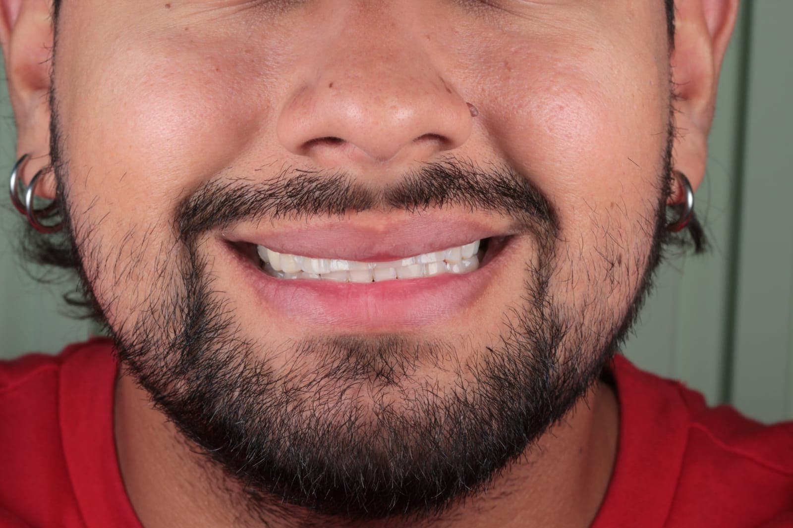 Before Microdiseño en resina de alta estética