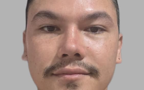 After Male rhinoplasty